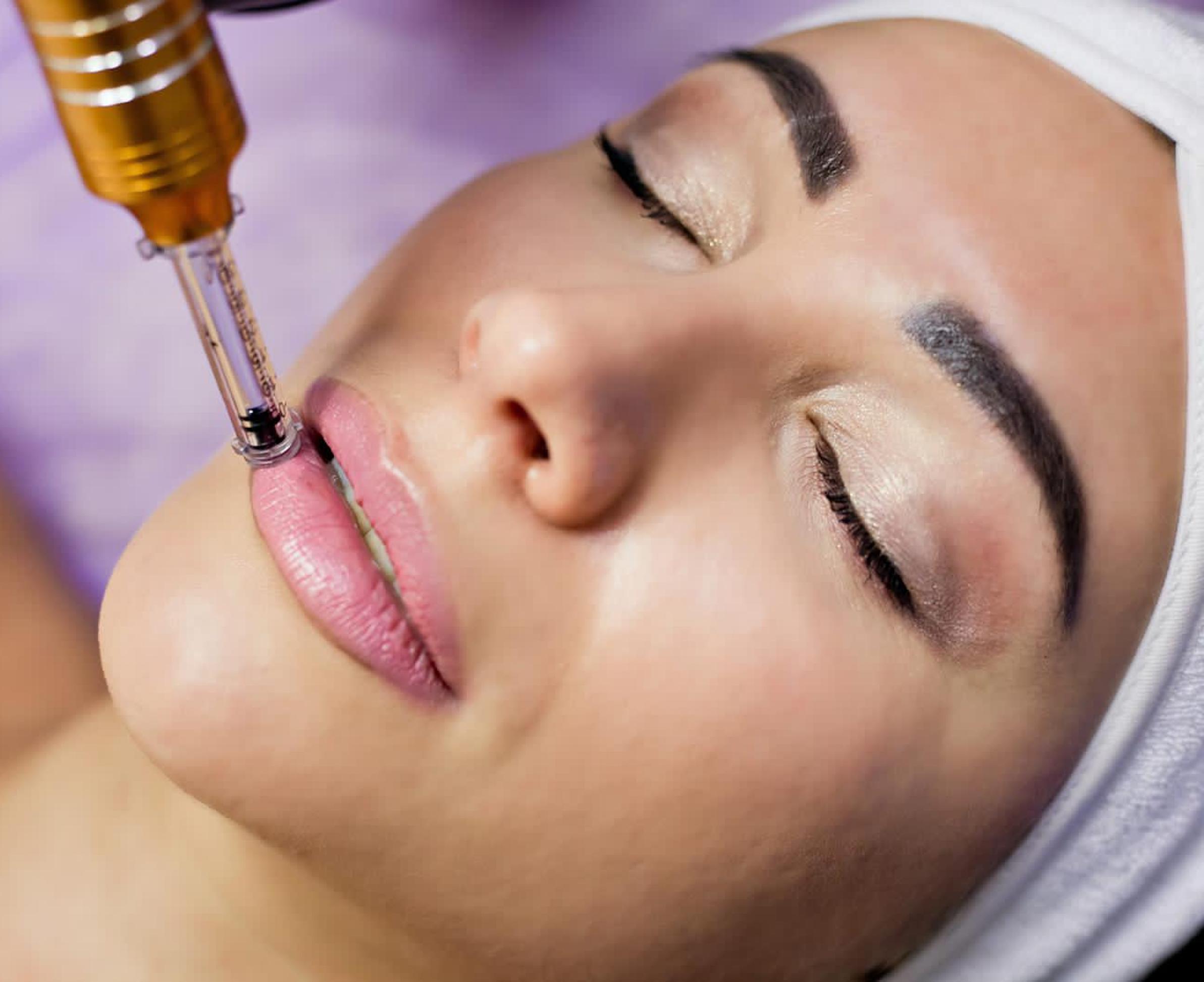 Hyaluron Pen Filler treatment at Robin's Day Spa