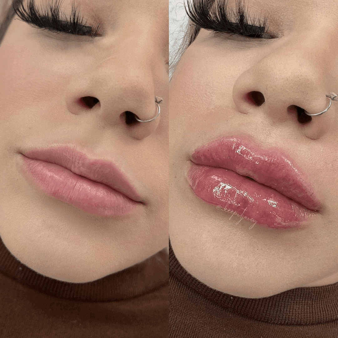 Hyaluron Pen before and after