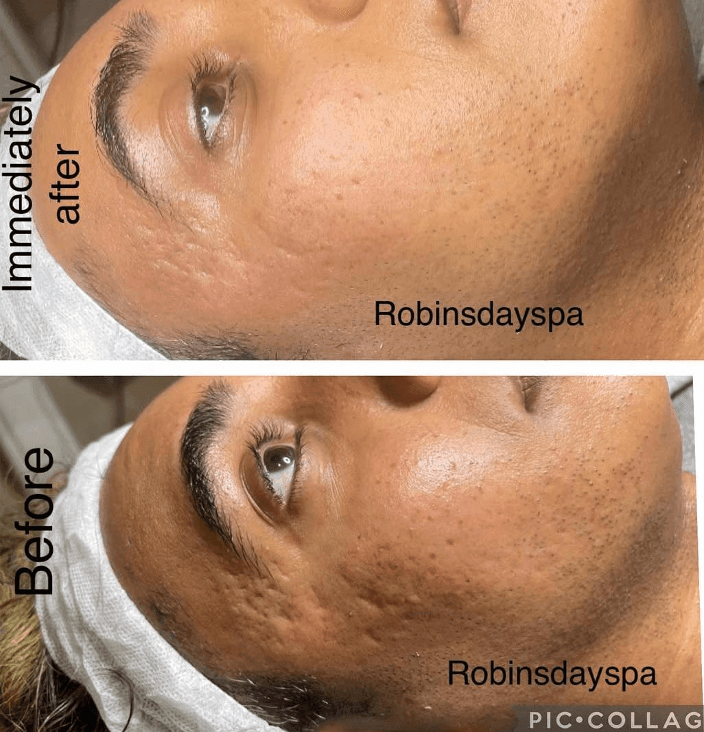 Microneedling before and after