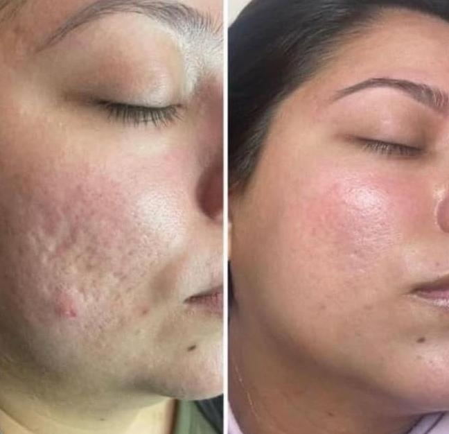 Skin Renewal before and after