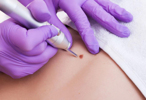 Skin Tag Removal treatment at Robin's Day Spa